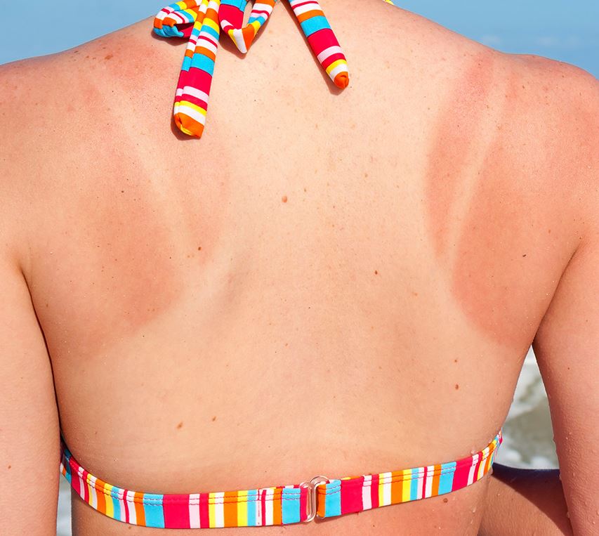 hilfe gegen sonnenbrand - Sonnenbrand – Was nun? Die besten Tipps gegen Sonnenbrand!